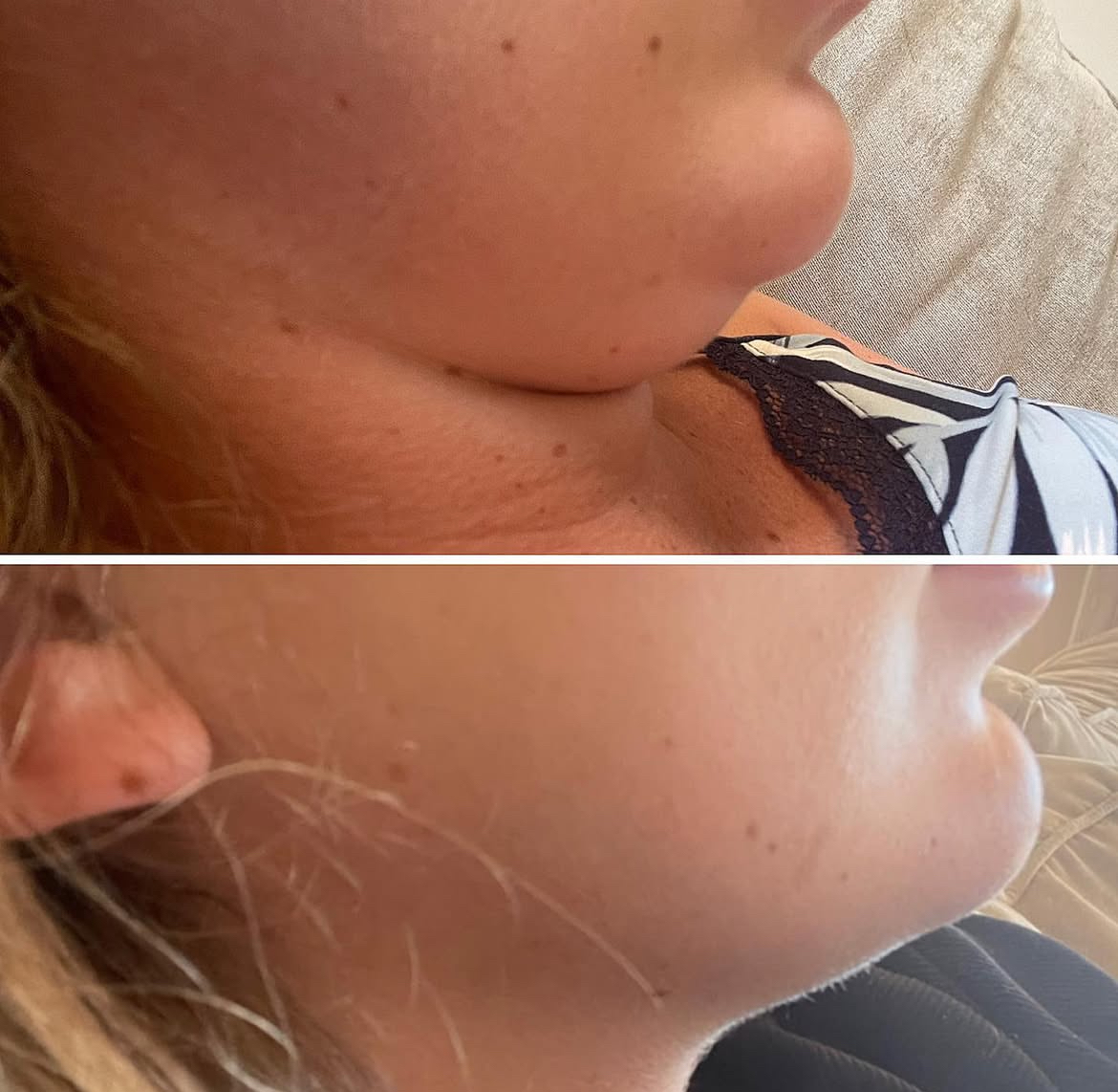 Chin Fat Dissolving Results